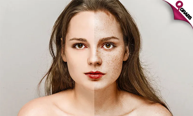 Laser Rejuvenation for Dark Lips & Freckles/Sunspots Treatment!